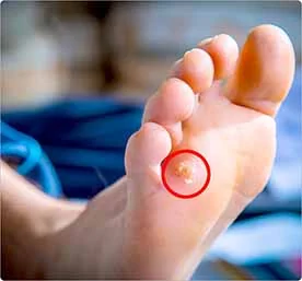 凹足（ハイアーチ）